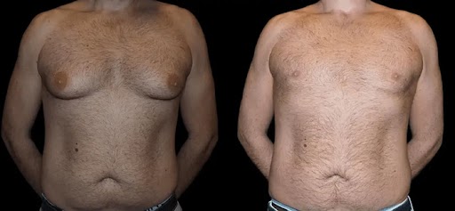 Post-Surgery Care for Male Breast Reduction