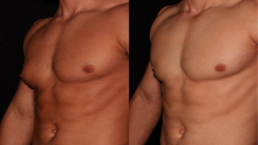 Combining Gynecomastia Surgery with Other Cosmetic Procedure